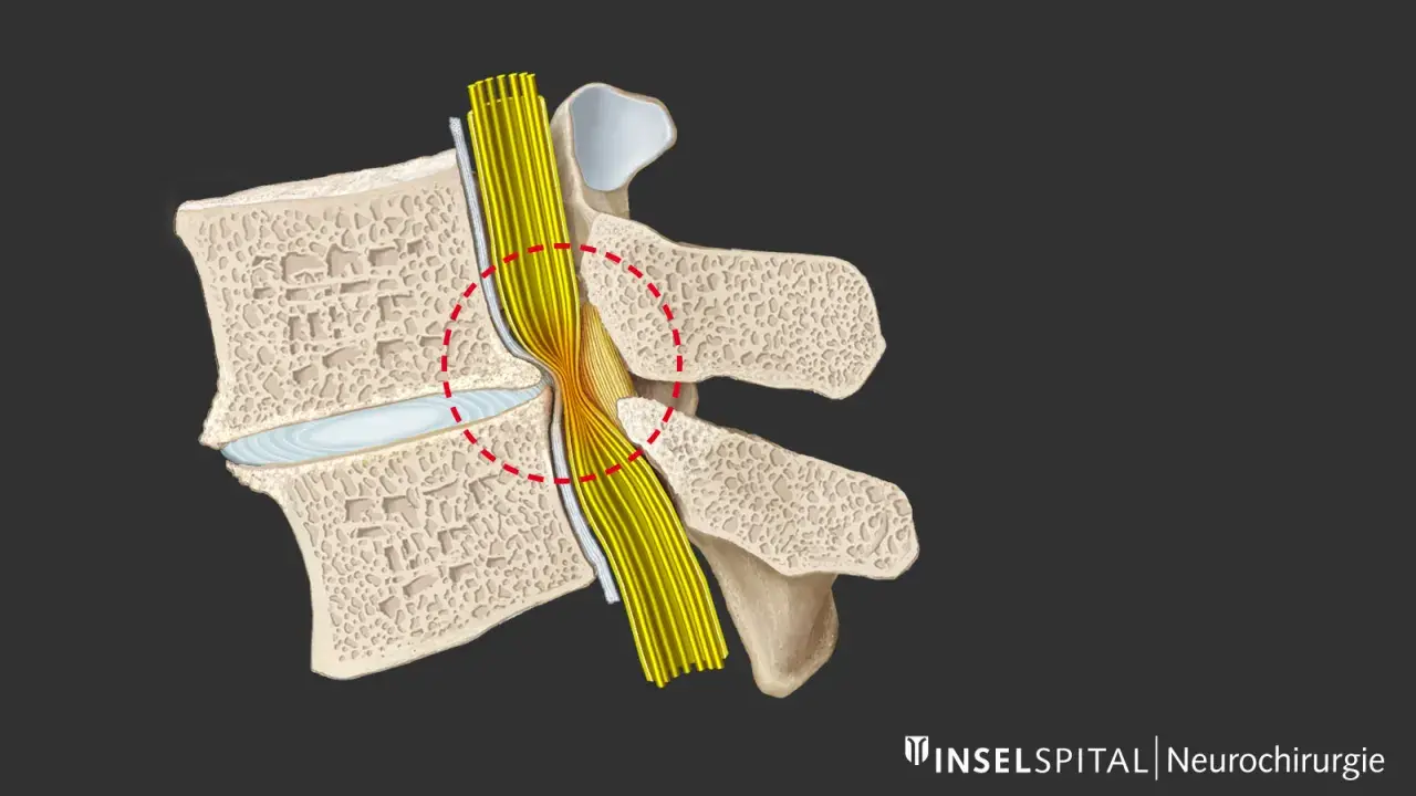 Darstellung einer Spinalkanalstenose, die Nervenwurzeln komprimiert. Eine Operation kann hier Linderung verschaffen.