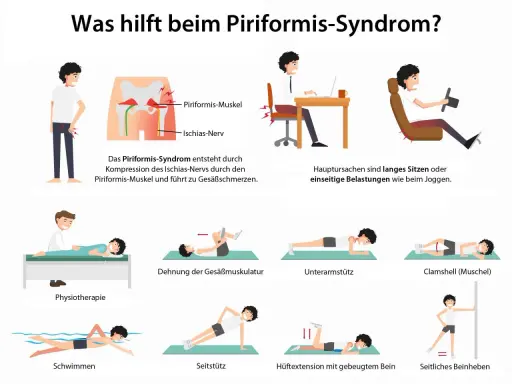 Illustrationen zeigen Übungen zur Linderung des Piriformis-Syndroms, wie Dehnung der Gesäßmuskulatur, Physiotherapie und Schwimmen.