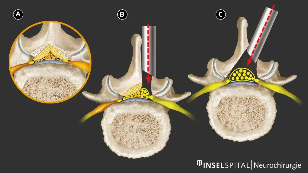 Illustration zeigt die Schritte einer spinalkanalstenose operation: Dekompression des Nervs durch Entfernung von Knochen und Gewebe.
