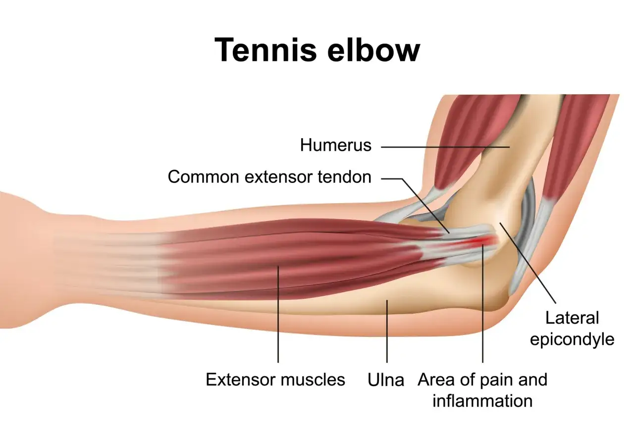 Illustration zeigt den Tennisarm. Schmerzen beim Strecken des Ellenbogens entstehen durch Entzündung am Sehnenansatz.