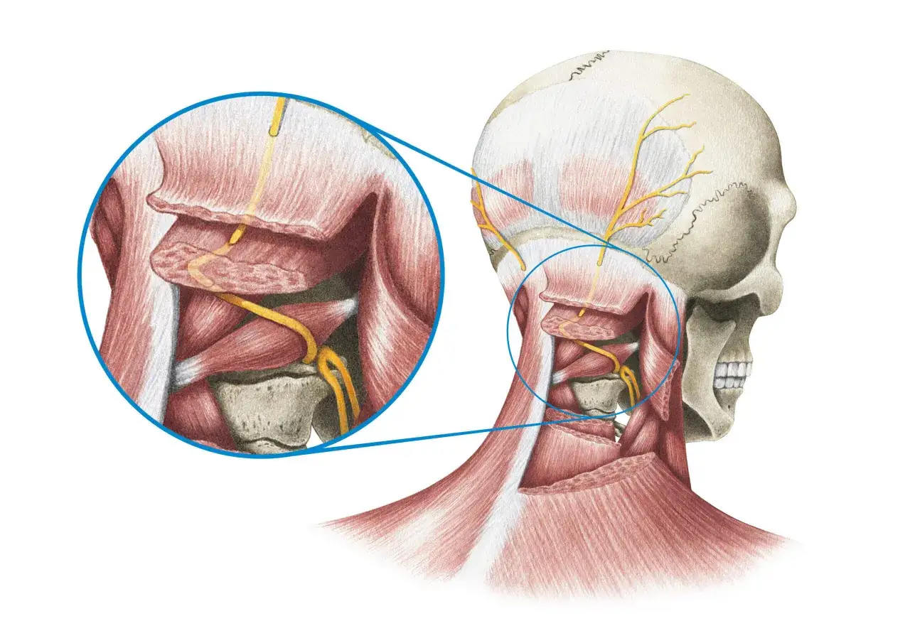 Anatomische Darstellung des menschlichen Sch&auml;dels und Nackens mit Muskeln und Nerven. Vergr&ouml;&szlig;erter Ausschnitt zeigt Nervenverlauf, der bei Reizung Schmerzen seitlich am Hals entlang verursachen kann.