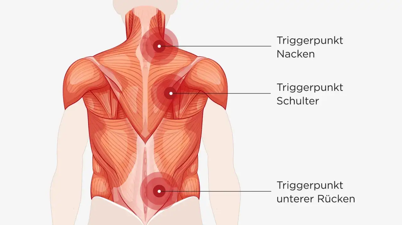 Muskelansicht des Rückens mit markierten Triggerpunkten an Nacken, Schulter und unterem Rücken. Husten kann Nackenschmerzen verursachen.