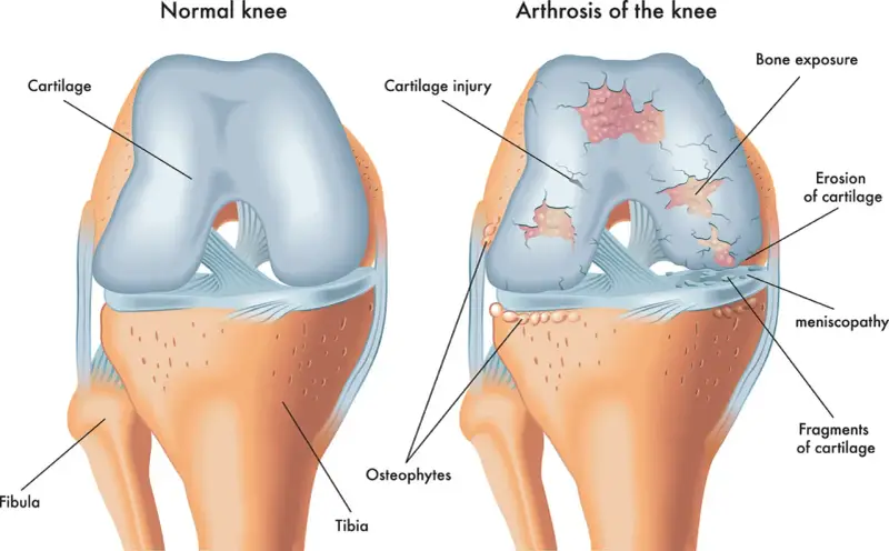 Vergleich eines gesunden Knies mit Arthrose. Arthrose zeigt Knorpelschäden, Knochenexposition und Osteophyten, was zu steifen Gelenken führt.